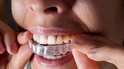 Un juzgado de Madrid investiga las denuncias de cientos de usuarios de alineadores dentales de bajo coste