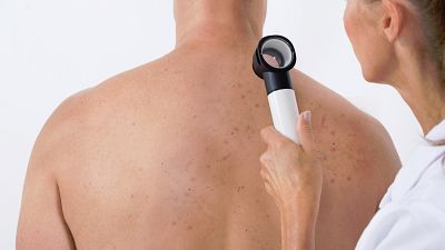 La mortalidad por melanoma baja por primera vez en menores de 65 años, aunque sube en los mayores