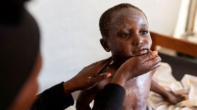 Por qué la mpox es distinta a la COVID-19 y por qué la mejor respuesta es  la "solidaridad" con África