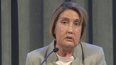 La Carme, pacient receptora del trasplantament de cara en roda de premsa explicant el seu cas