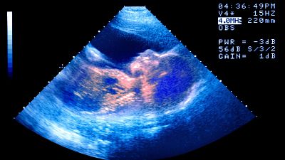 El embarazo por reproducción asistida: un deseo cumplido, una proeza médica, ¿un negocio?