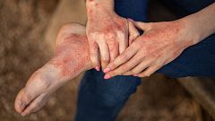 Sanidad aprueba el uso de Bimzelx, un innovador medicamento contra la psoriasis