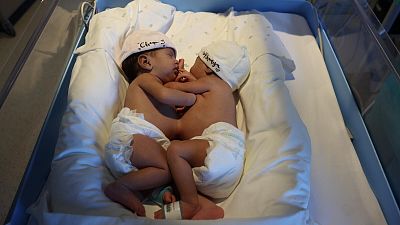 Separadas con éxito en Barcelona dos bebés siamesas mauritanas unidas por el abdomen