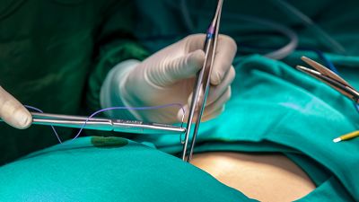 El primer trasplante de hígado de un cerdo a una persona en muerte cerebral da esperanzas para su futuro uso