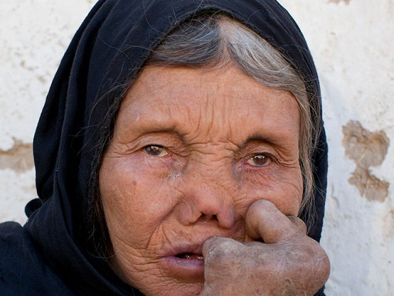 Cada año se diagnostican 250.000 casos de lepra