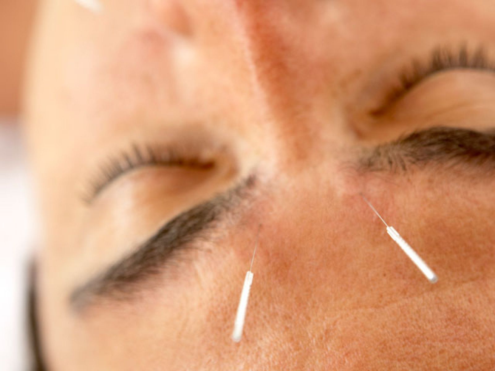 Acupuntura para dejar de fumar