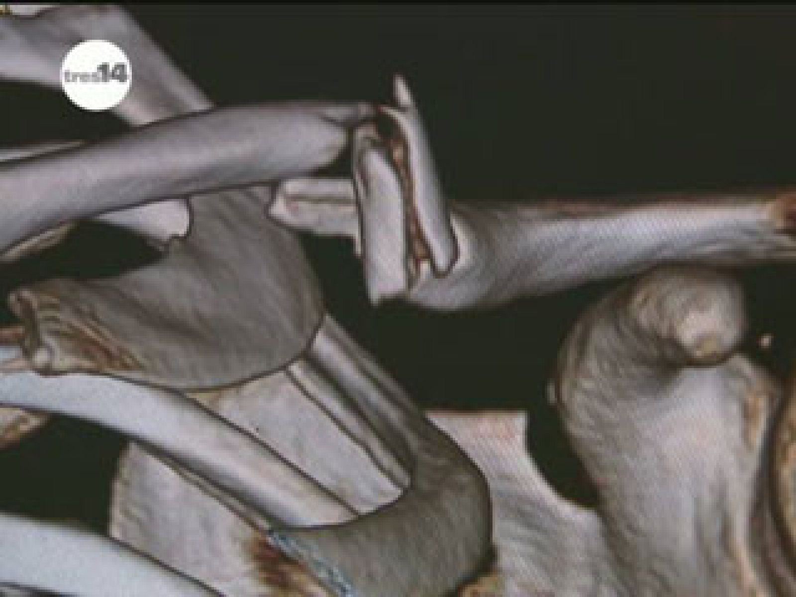 Las fracturas más frecuentes de los pilotos | Ver