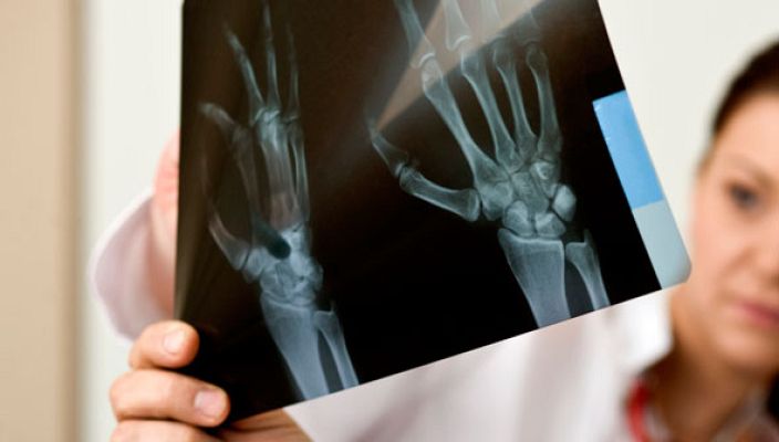 La mañana - Tener los huesos fuertes