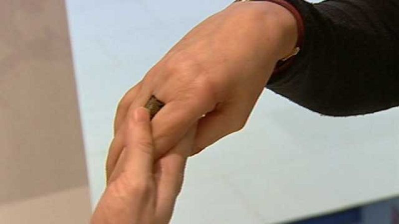 30 años de la reimplantación de una mano