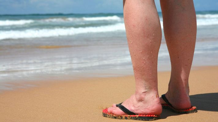 La mañana - Varices, arañas y manchas rojas