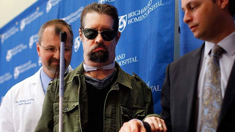 Un paciente de Boston (EE.UU.), el segundo en recibir un transplante total de cara