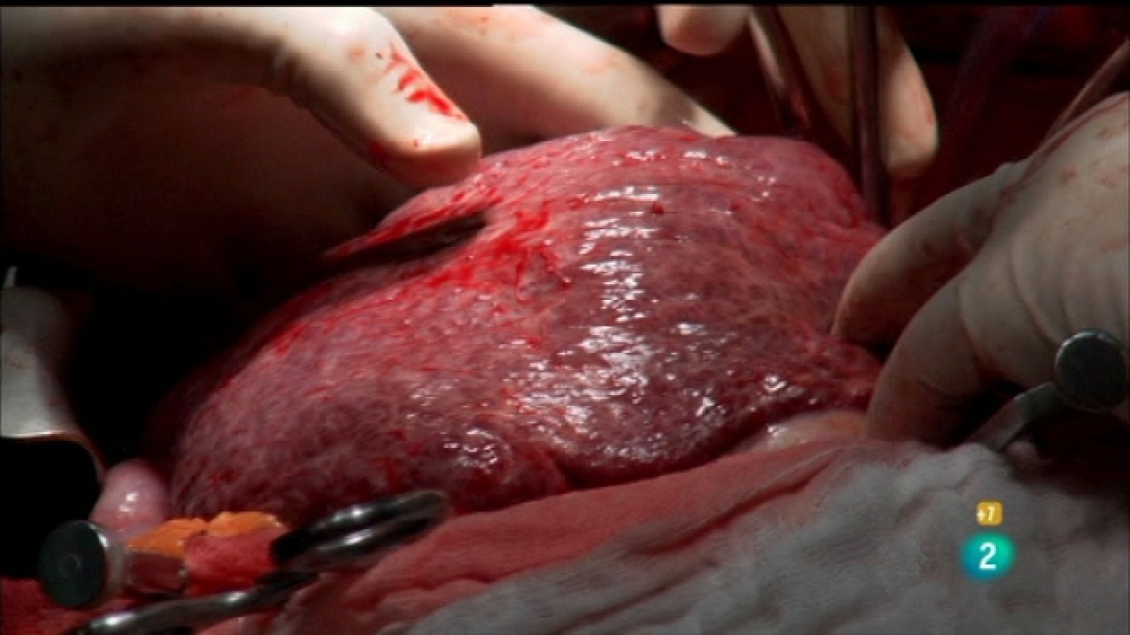 La noche temática - El mercado de los órganos - Ver ahora