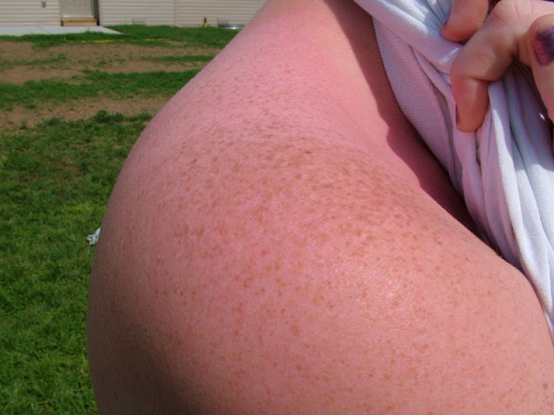 Más de 700.000 personas mueren al año por los melanomas