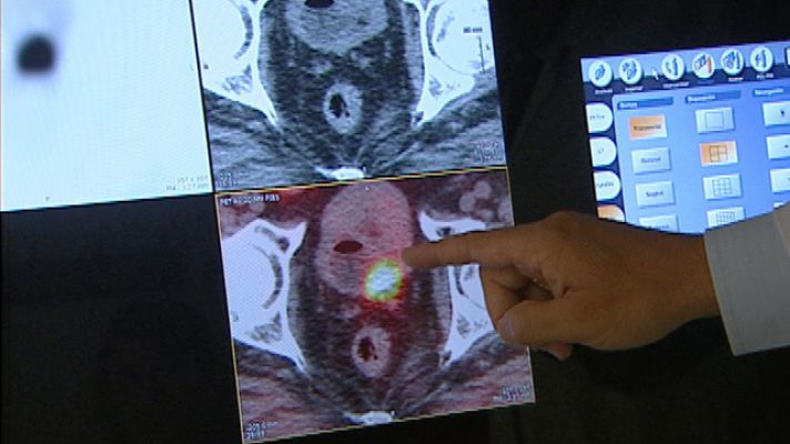 Telediario 1 - Revisiones de próstata