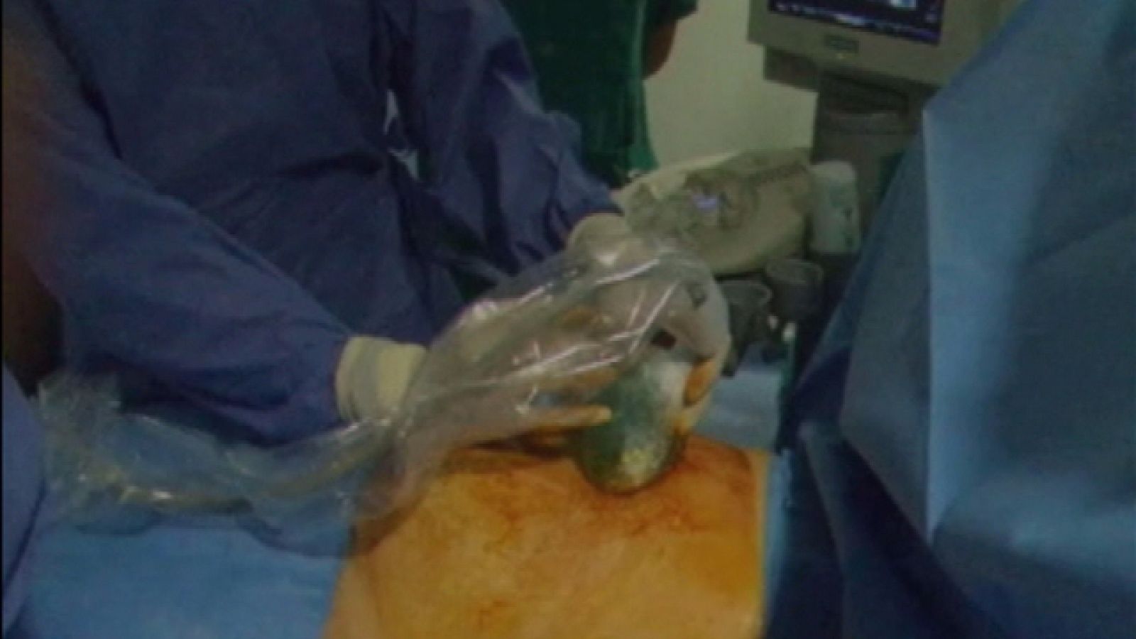 Valvuloplastia a un feto de 22 semanas