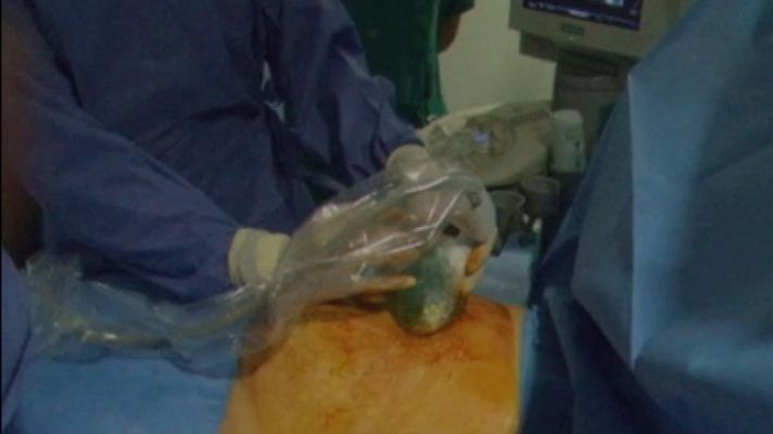 Telediario 1 - Valvuloplastia a un feto