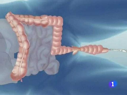Telediario 1 - Extracción completa del colon
