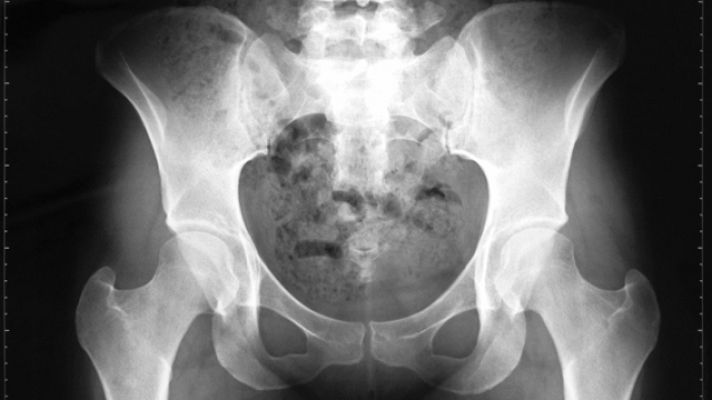 La mañana - Cuando los huesos se desgastan