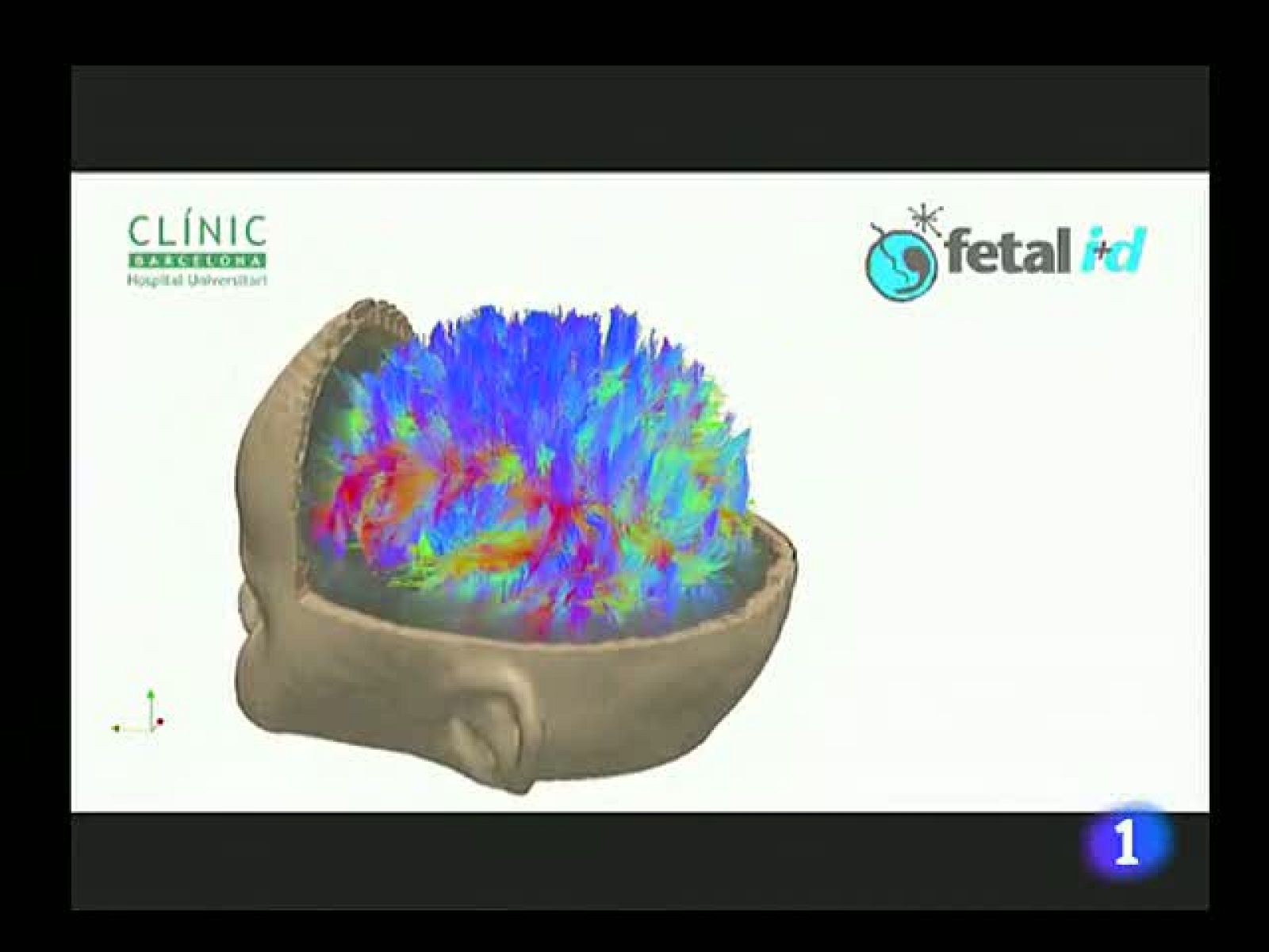Reproducen la imagen de las conexiones neuronales de niños que sufren un retraso cognitivo leve