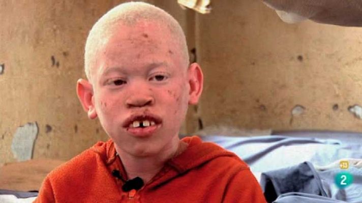 La noche temática - La caza de albinos en África