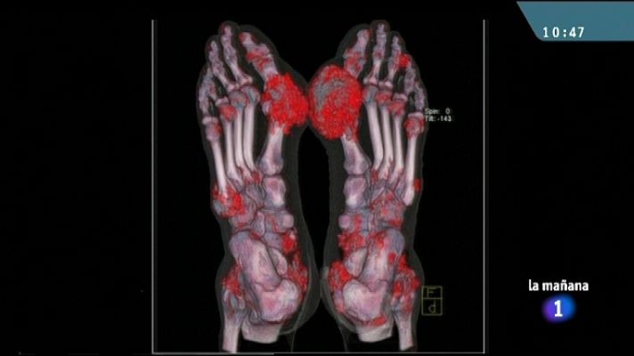 La mañana - Ácido úrico al final del año