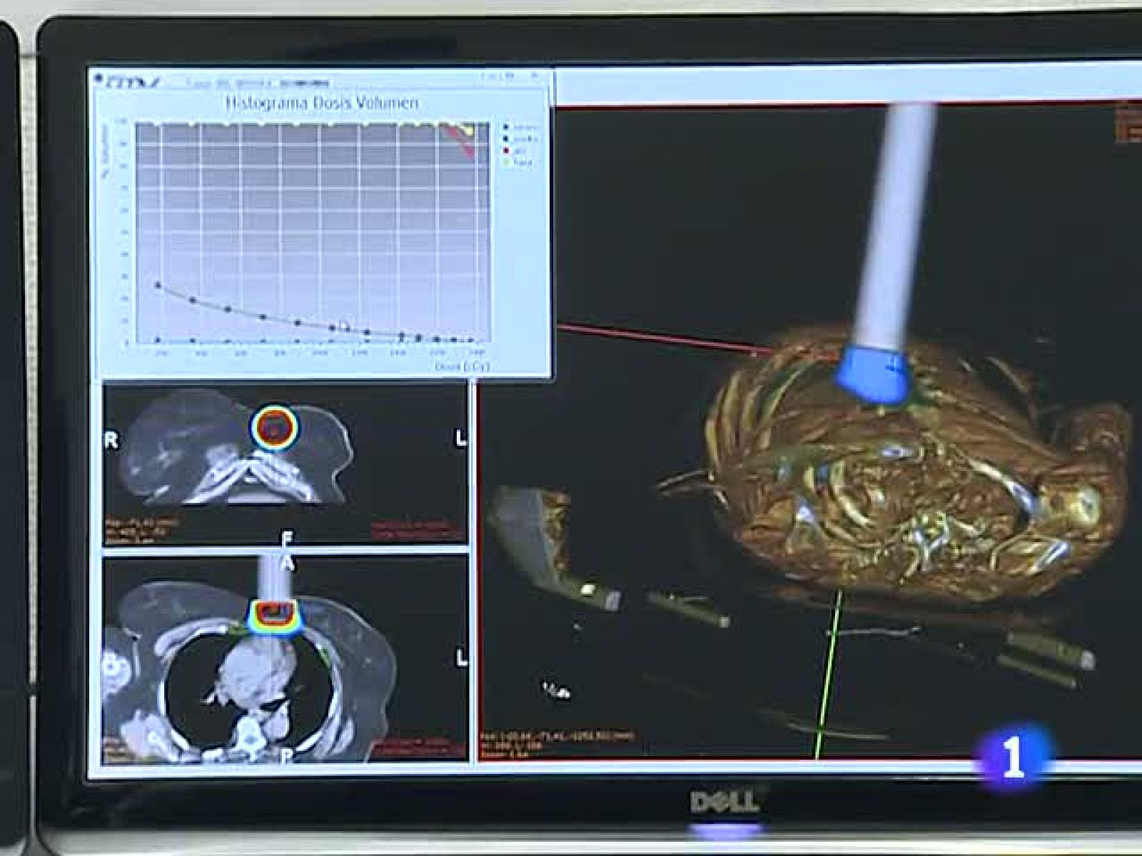 Primer simulador del mundo de cirugía virtual de cáncer
