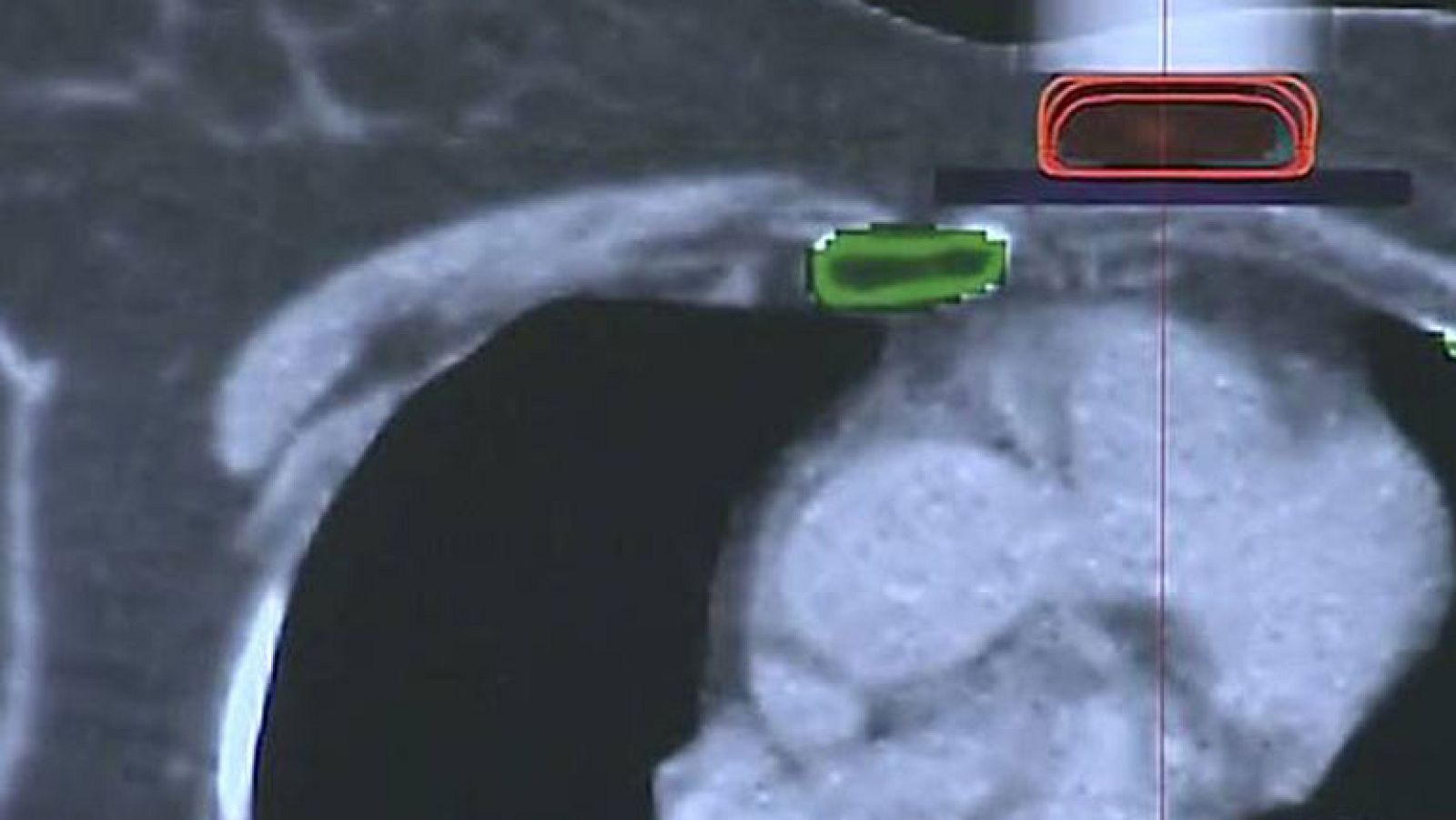 Un nuevo simulador de radioterapia permite practicar a los oncólogos antes de las operaciones | Ver