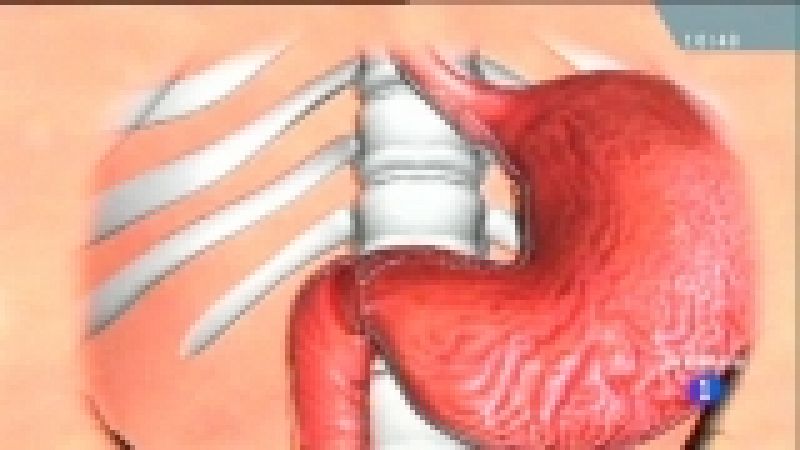 Saber vivir - Reflujo y hernia de hiato - 24/01/12