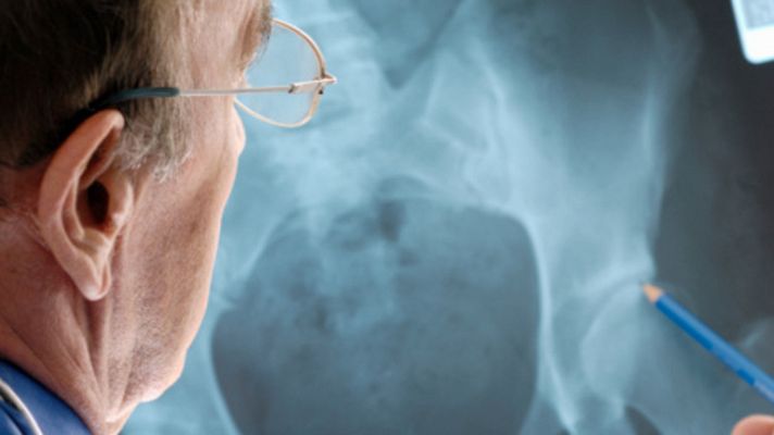 La mañana - Cómo tener los huesos fuertes