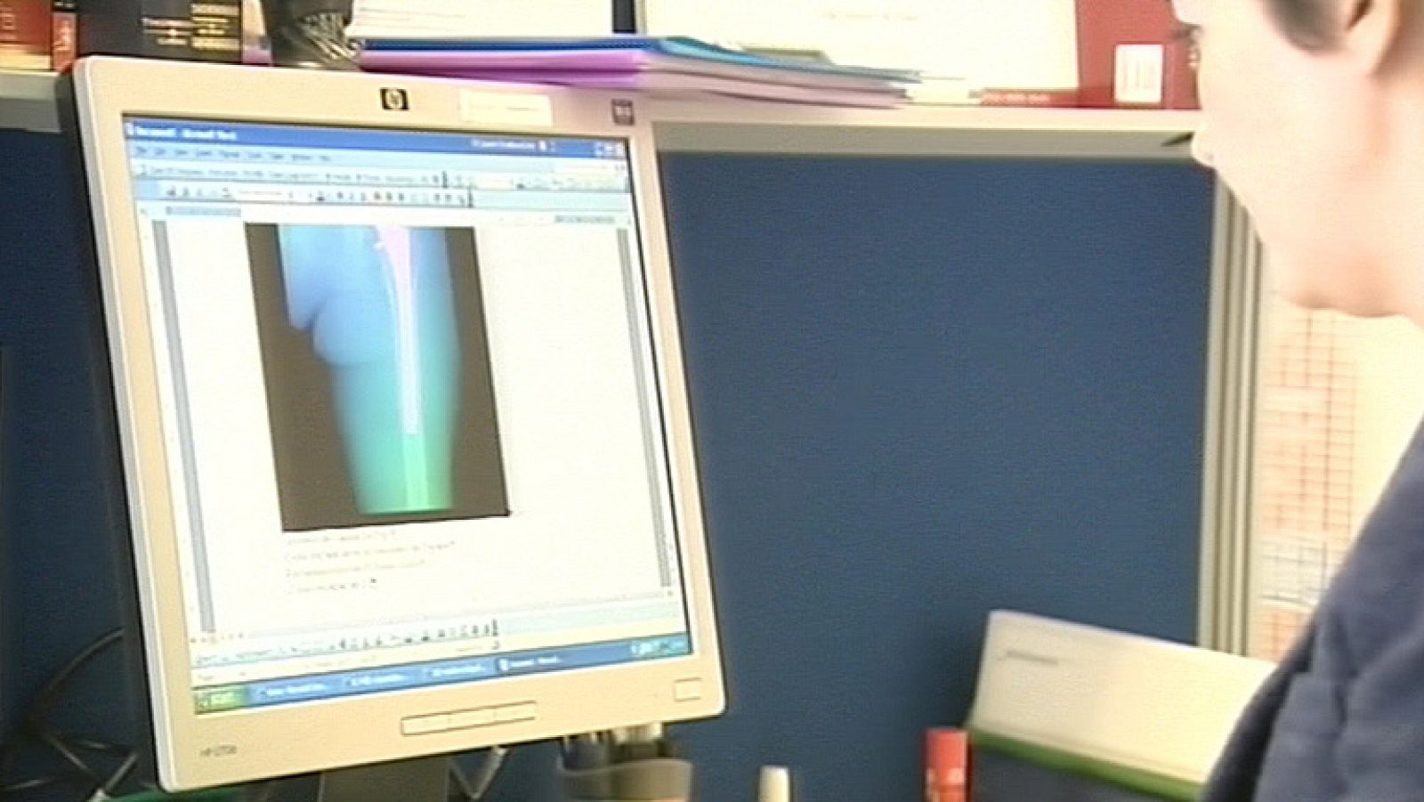 Las protésis Jhonson and Jhonson pueden provocar problemas de salud