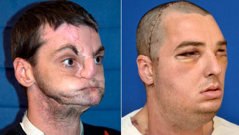 Un estadounidense recibe el transplante de cara más completo de la historia