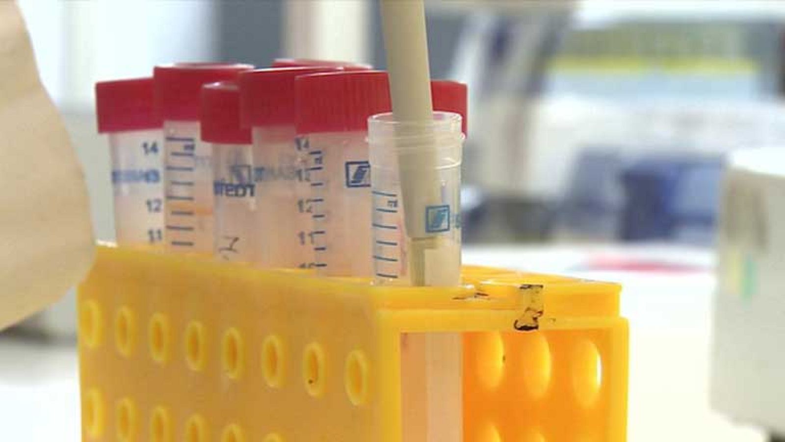 Intestino irritable, una enfermedad crónica digestiva