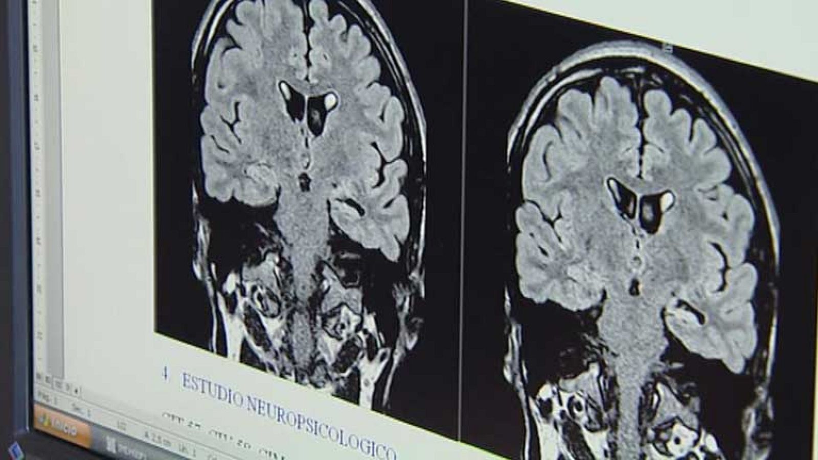 Como atender a alguien que sufre epilepsia