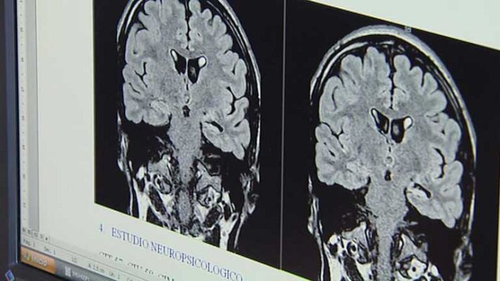 Telediario 1 - Día nacional de la epilepsia