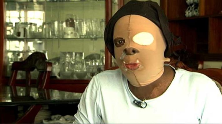 Telediario 1 - Víctimas de ataques con ácido