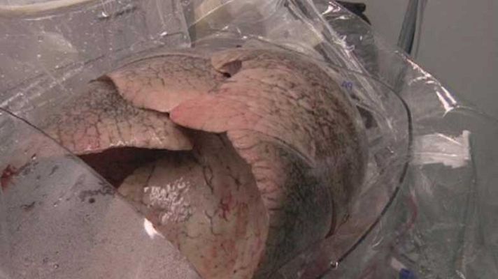 Telediario 1 - Recuperación de órganos