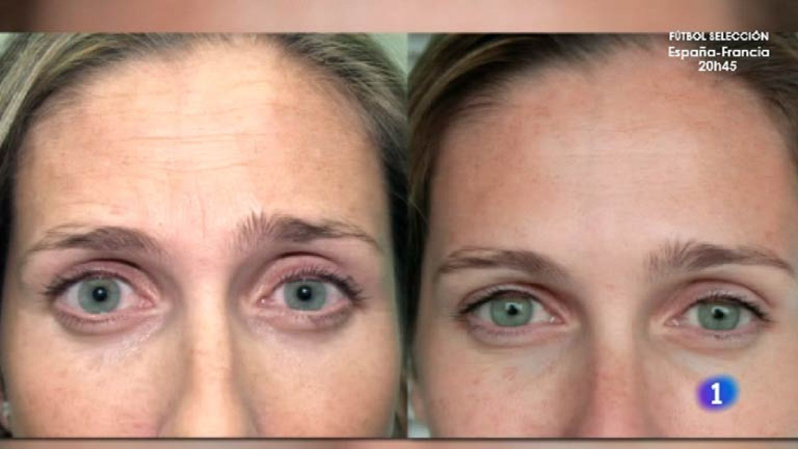 Más Gente - El doctor Sopena nos desvela los beneficios del bótox