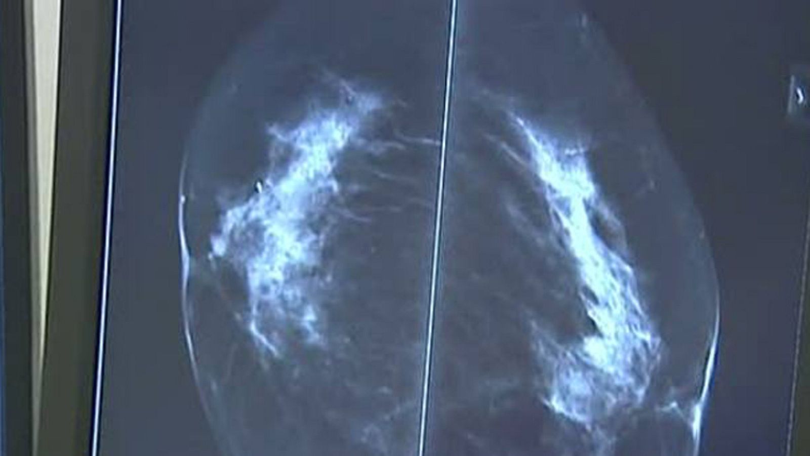 Cáncer de mama durante el embarazo, una dificultad añadida pero no fatal