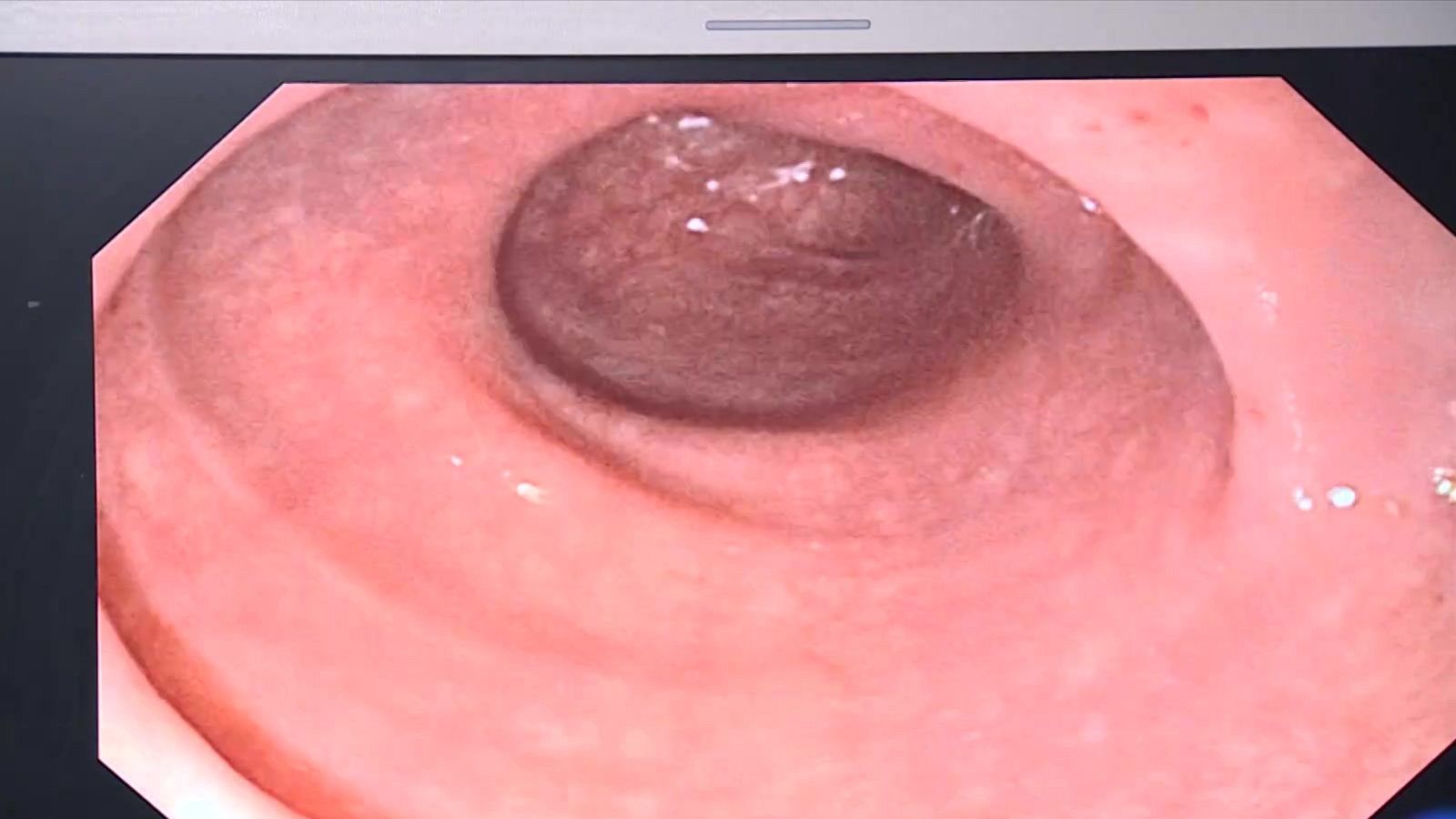 Catalunya registra 7.000 casos de càncer de còlon en el darrer any - L'Informatiu | Veure