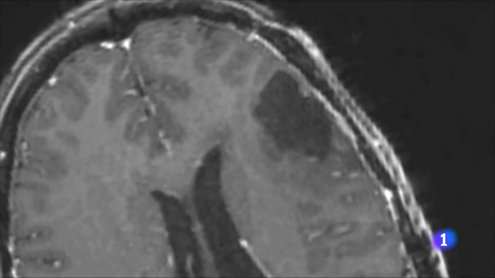 El Glioblastoma, el tumor cerebral més comú i letal - L'Informatiu | Veure