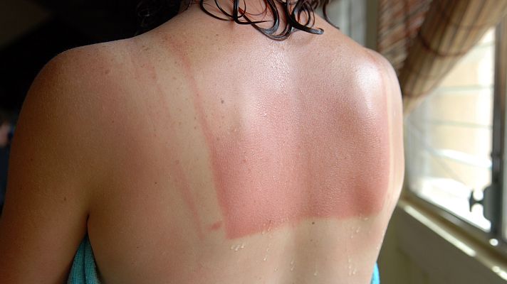 Telediario 1 - "Callo solar", un mito peligroso de las redes sociales que puede ocasionar cáncer