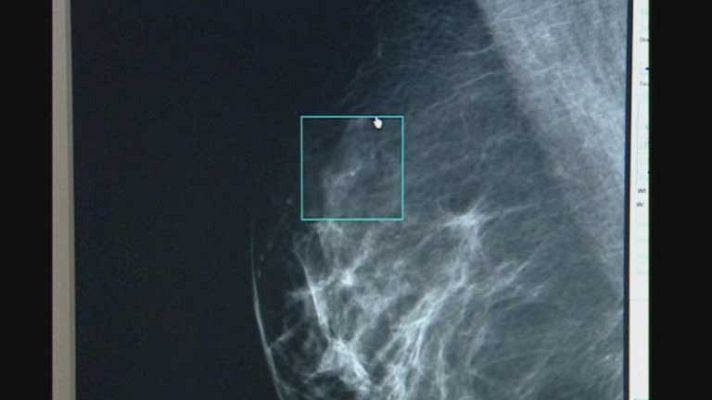 Telediario 1 - Cáncer de Mama