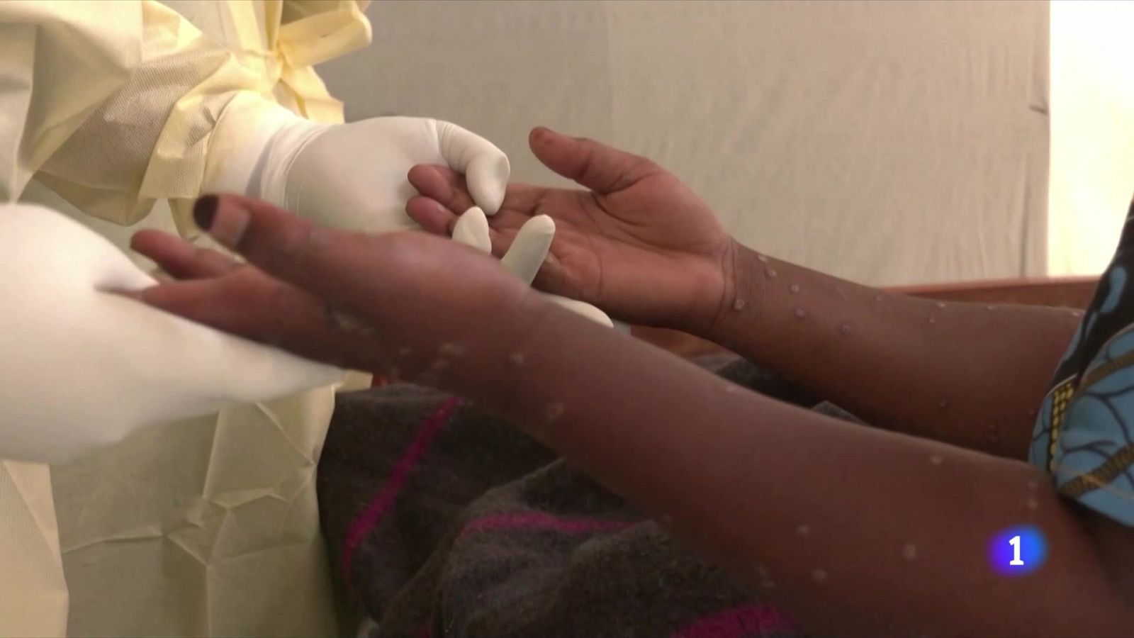 La UE considera baix el risc d'expansió de la verola del mico - L'Informatiu | Veure