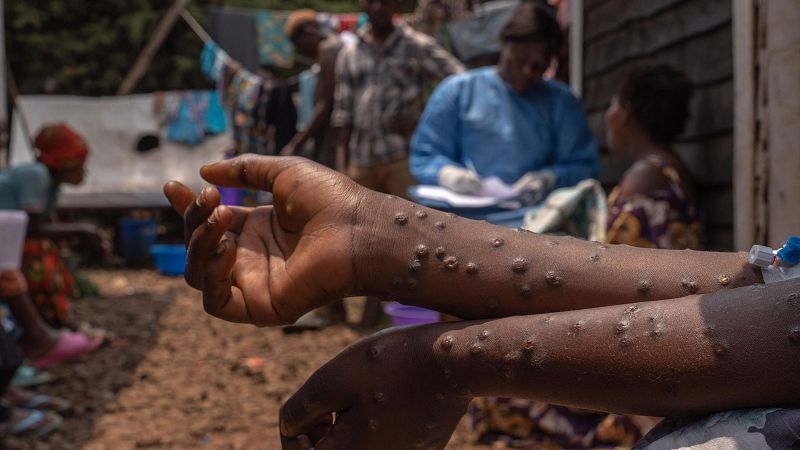 La comunidad médica internacional reitera que África necesita ayuda contra la mpox | Ver