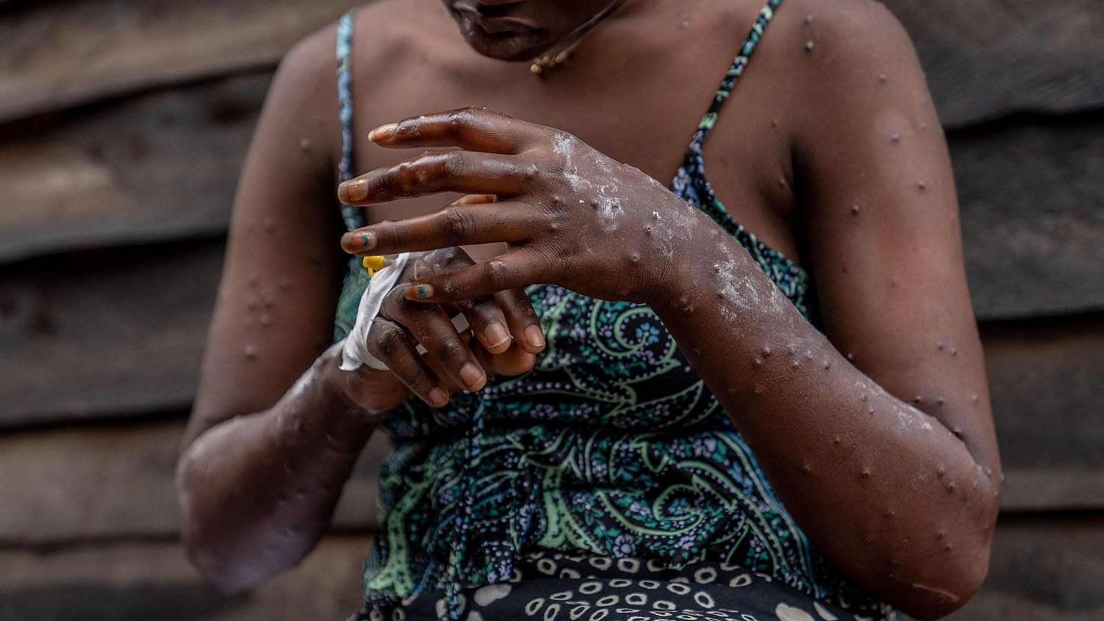 La mpox se extiende por la República Democrática del Congo | Ver