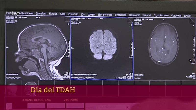 Día del TDAH | Ver