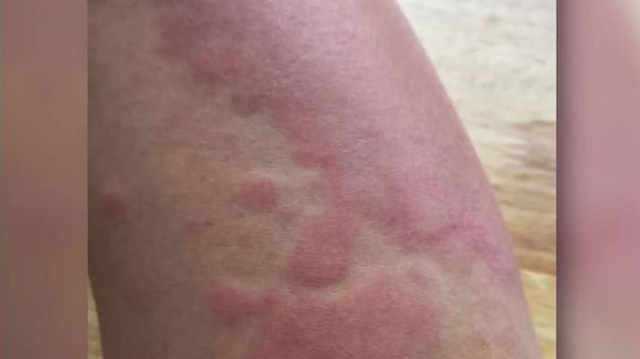 Mañaneros 360 - Una picadura de abejorro le causó a Mari Carmen una reacción anafiláctica que le produjo un aborto