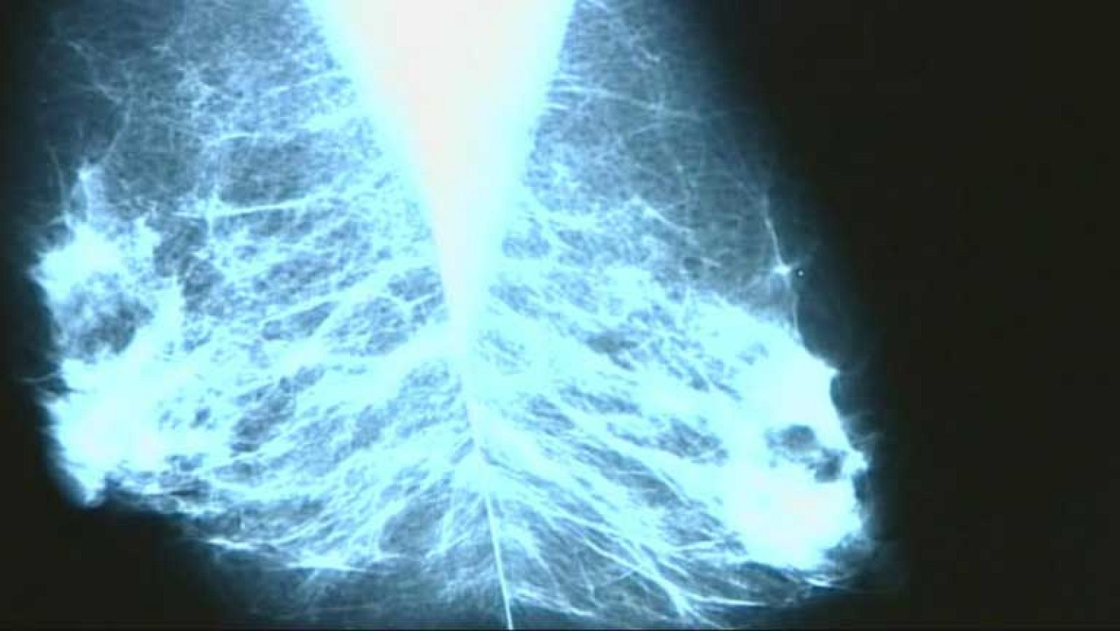 Tratamiento preventivo contra el cáncer de mama en Reino Unido