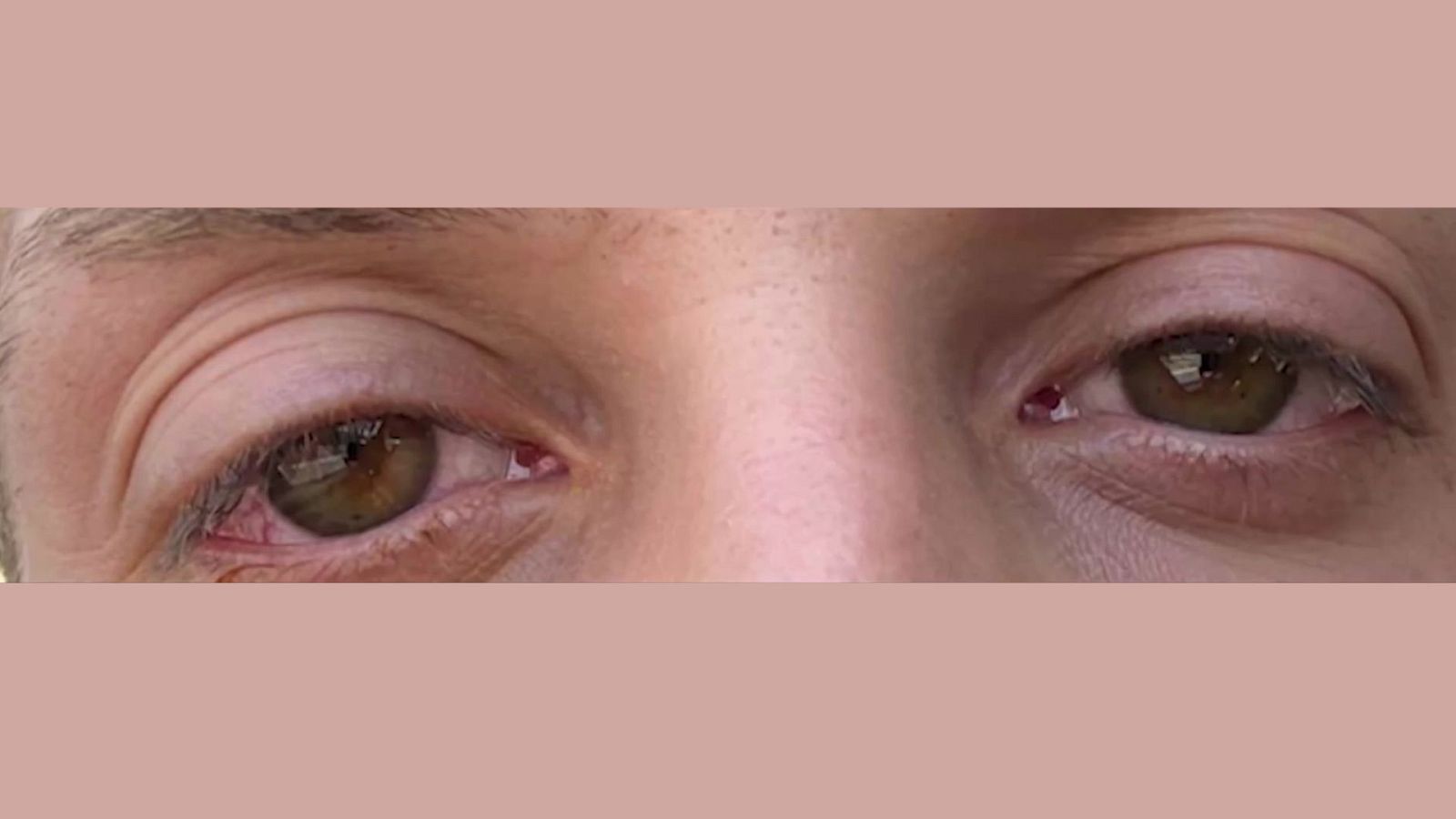 Lesiones oculares tras ir a la feria - Mañaneros 360 | Ver