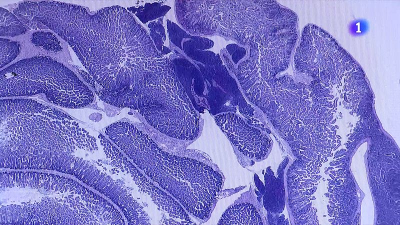 Les telomeropaties, malalties genètiques rares: "Agafava una grip cada tres mesos"